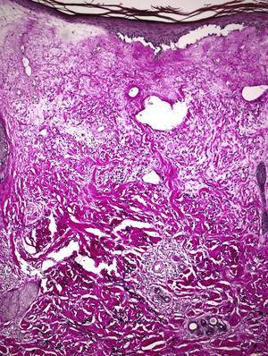 Histopathology showing an atrophic epidermis, collagen with a hyalinized appearance, and a band-like lymphocytic infiltrate. The reticular dermis is thickened, and contains thick and compact collagen bundles. Stain for elastic fibers, original magnification×100.
