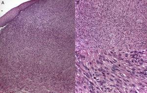 Diffuse, poorly defined fascicles interspersed with smooth muscle fibers composed of fusiform cells with cigar-shaped nuclei (elongated with rounded tips), marked pleomorphism, and an eosinophilic cytoplasm. Hematoxylin-eosin, magnification: A, ×10; B, ×20; C, ×40.