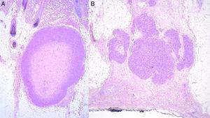 A, Primary subcutaneous leiomyosarcoma. B, Skin metastasis from a noncutaneous leiomyosarcoma.