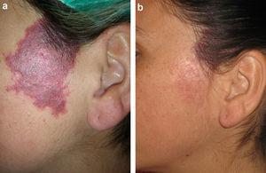 A, Violaceous capillary malformation without associated hypertrophy. B, Marked improvement after 3 treatment sessions.