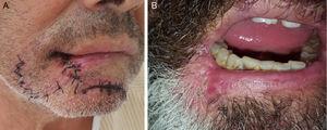 A, Early postoperative state. B, The oral commissure 1 month after closure.