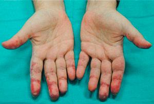 Anti-MDA5–Positive Dermatomyositis: A Description of the Cutaneous and ...