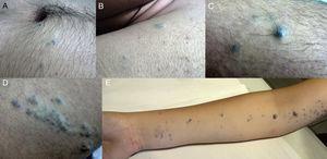 A-E, Clinical presentations of glomuvenous malformations. Bluish or violaceous papules and nodules, some with a linear and dermatomal distribution.