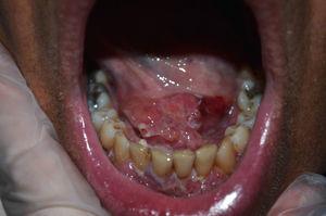 Friable erosive lesions on the base of the tongue.