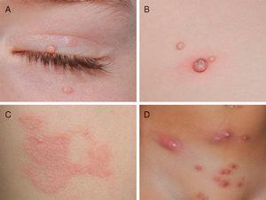 Different clinical manifestations of molluscum contagiosum (MC). A, Pink papules on the eyelids with typical central umbilication. B, Sessile lesion of less typical morphology next to other lesions more characteristic of MC. C, Eczematiform reaction (molluscum dermatitis) surrounding MC lesions. D, Inflamed and abscessed lesions on the abdomen.