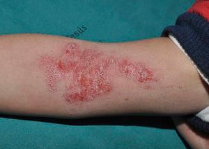 Irritation caused by the application of topical imiquimod on the right forearm.