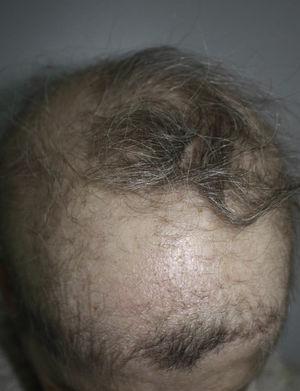 The patient presented congenital wiry, sparse, pale hair on the scalp, eyebrows and eyelids, due to ectodermal dysplasia.