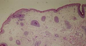 Skin biopsy specimen from the scalp showing the presence of rudimentary hair structures and total absence of sebaceous glands, co ncordant with ectodermal dysplasia.