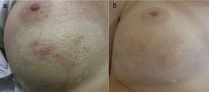 Clinical presentation. (1) Before pulsed-dye laser treatment. Erythema with telangiectasias associated over the lower half of the right breast. (2) 3 months after pulsed-dye laser. A significant clearance of the erythema can be observed, although a mild hyperpigmentation was associated due to the treatment.