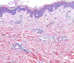 Histopathological examination (HE 10x). Vascular dilatation with mild perivascular lymphocitic infiltrate. Neither mucine nor fungal agents are observed.