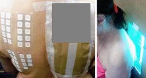 Placement of the sets of skin patches (left) and subsequent irradiation at 48h (right).