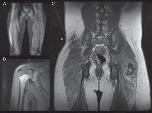 Magnetic resonance imaging (MRI) findings. A, Patient #1. Whole-body muscle MRI. Increased intensity in STIR (short tau inversion recovery) sequence of buttock region and vastus lateralis, consistent with muscle edema, a sign of muscle inflammation. Integration of this finding confirmed the diagnosis of juvenile dermatomyositis. B, Patient #4. MRI of shoulder muscle. Increased signal from right deltoids and fascia in association with a small quantity of liquid in the subacromial bursa. C, patient #5. Whole-body muscle MRI after initiation of treatment. Note the hypointense calcinosis cutis plaque in the right low lumbar region (*).