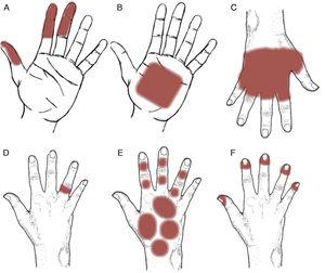 Clinical patterns of allergic contact dermatitis affecting the hands. A, Pincer grip pattern. B, Palmar grasp pattern. C, Apron pattern. D, Ring pattern. E, Glove pattern. F, Periungual pattern.