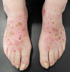 Allergic contact dermatitis with a shoe pattern.