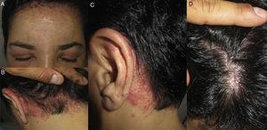 A-D, Allergic contact dermatitis caused by paraphenylenediamine in black hair dye. A, Involvement of the forehead and eyelids. B and C, Involvement of the retroauricular area and nape of the neck. D, Scarce involvement of the scalp.