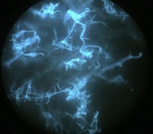 Calcofluor-white staining reveals numerous fungal structures consisting of broad, branched, aseptate hyphae compatible with mucormycosis.