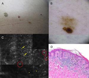 Clinical, dermoscopy, reflectance confocal microscopy (RCM), and histology findings. A, Light brown nevus (4mm) in the lumbar region with asymmetry and a hyperpigmented area. B, Dermoscopic island: dermoscopy reveals a homogenous reticular pattern within which lies an area of eccentric hyperpigmention with a distinct, atypical reticular pattern. C, RCM image showing isolated atypical round cells (arrows), atypical cells forming nests (circles), and papillae with poorly defined contours (asterisks). D, Proliferation of large atypical melanocytes with prominent, hyperchromatic nucleoli corresponding to the dermoscopic island (hematoxylin-eosin, original magnification ×100).