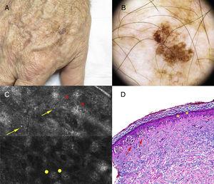 Clinical, dermoscopy, reflectance confocal microscopy (RCM), and histology findings. A, Lesion (2cm) on the back of the right hand with a 6-mm area of hyperpigmentation. B, Dermoscopy reveals a homogenous reticular pattern throughout most of the lesion, and an atypical globular pattern corresponding to the area of eccentric hyperpigmentation. C, RCM of the area corresponding to the atypical globular pattern reveals papillae with poorly defined contours (asterisks), discohesive nests (dots), and atypical cells (arrows). D, Melanoma in situ with a predominantly lentiginous pattern, with single-cell pagetoid invasion (asterisks) and some groups of atypical cells (arrows) (hematoxylin-eosin, original magnification ×100).