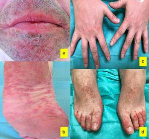 Case 1 clinical presentation: A, Honey-colored crusts around the mouth; B, Erythematous macules on the soles of the feet. Case 2 clinical presentation: C, erythematous papules on the dorsum of the hands; D, Isolated and confluent erythematous papules on the dorsum of both feet with a distal distribution.