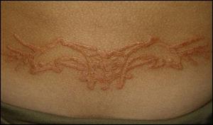 Eczema over a henna tattoo. The limits of the eczema are marked by the lesions.
