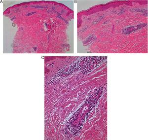 (a, x40; b, x100; c, x200) Histopathological examination (H&E) revealed an epidermis without significant changes and a perivascular histolymphocytic infiltrate in the superficial and deep dermis. There is no evidence of vasculitis.