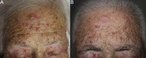 Erythematous desquamative lesions on the patient's forehead (A) that resolved after 8 cycles of panitumumab therapy (B).