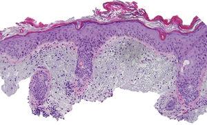 Histological image showing atypical keratinocytes in the basal layer of the epidermis and hyperkeratosis in the follicular infundibulum. Solar elastosis, melanophages, and predominantly perifollicular lymphocytic infiltrate are evident in the dermis (hematoxylin and eosin, original magnification×10).