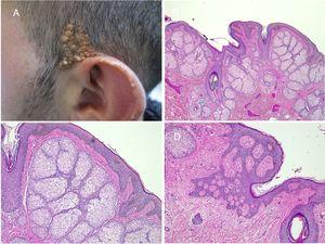 Nevus sebaceus in the left temporal region of a young patient. A,Clinical image. B,(Hematoxylin and eosin [HE], 4×): histological image showing the presence of epidermal acanthosis and multiple large sebaceous glands abnormally found high in the reticular dermis. C,(HE, 10×): detail of the sebaceous glands. D,(HE, 10×): acanthosis acquires a reticulated appearance in some areas, resembling adenoid seborrheic keratosis.