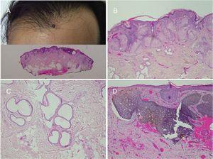 Basal cell carcinoma over nevus sebaceus. A,Clinical image and low-resolution histological view (Hematoxylin and eosin [HE], 2×). B,(HE, 4×): histological image showing hyperplasia of the sebaceous and apocrine glands. C,(HE, 10×): Detail of decapitation secretion, characteristic of apocrine glands. D,(HE, 10×): detail of the basal cell carcinoma.