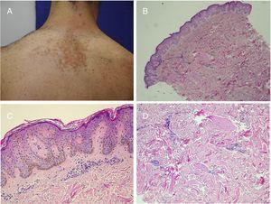 Becker nevus. A,Clinical image. B,(Hematoxylin and eosin [HE], 4×): low resolution image showing the presence of epidermal acanthosis, hyperpigmentation of the basal layer, and presence of smooth muscle fibers in the reticular dermis. C,(HE, 10×): detail of the epidermal changes. D,(HE, 10×): detail of the presence of smooth muscle fiber in the reticular dermis.