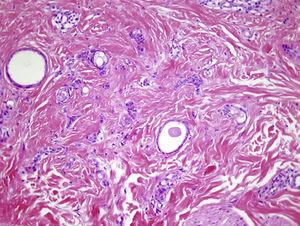 Biopsy reveals the presence in the dermis of ductal structures covered with a cuboid epithelium with comma-shaped prolongations (hematoxylin-eosin, original magnification ×200).