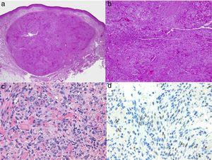 Histologie du sarcome de Kaposi. A, vue à faible grossissement du sarcome de Kaposi en phase nodulaire. Nodule dermique bien défini. B, Lésion très cellulaire avec quelques lacunes sous forme de fissures. C, Détail des cellules fusiformes et des globules rouges dans les petits vaisseaux. D, positivité nucléaire immunohistochimique pour HHV-8 spécifique du sarcome de Kaposi.