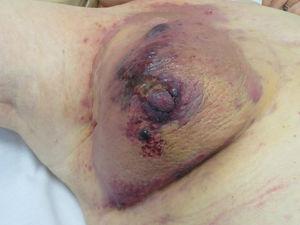 Angiosarcoma. Pápulas y nódulos rojizos-violáceos sobre una placa eritemato-violácea en una mama previamente irradiada por cáncer.