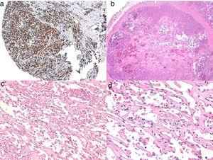 A, Immunohistochemistry of cutaneous angiosarcoma that is positive for ERG (typically with a nuclear pattern). B, Angiosarcoma with predominance of areas with vasoformative pattern. C, D, Detailed images of neoplastic endothelial cells, which in this case are prominent but without noteworthy atypia.