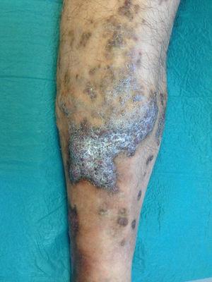 Image showing raised lesions with perilesional eczema in the anterior pretibial surface and outermost supramalleolar region. An ulcer with perilesional cutaneous hyperpigmentation is visible at the center of the image.