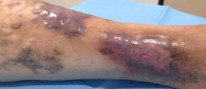 Healed ulcer after conservative medical treatment and compression therapy.