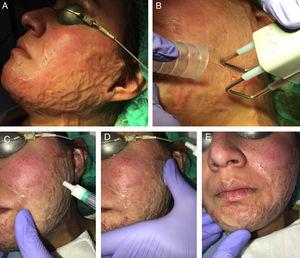 Example of delivery of triamcinolone acetonide assisted by ablative fractional CO2 laser in a patient with sequelae of a facial burn. A, Before treatment. B, Pass of CO2 laser with a fractional scanner over the whole surface of the facial burn; a smoke extractor is used alongside the treatment. C, Application of injectable triamcinolone acetonide 10% solution: the solution is applied topically over the area treated with the laser. D, Extension of the corticosteroid over the whole area of the burn. E, Smooth massage to ensure better penetration of the product. gr3.