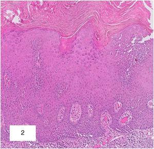 Asymptomatic Hyperkeratotic Plaque on the Glans in a Middle-Aged Man ...