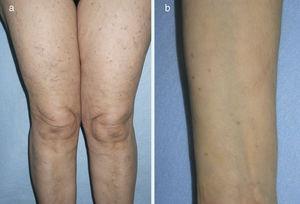 Clinical appearance of maculopapular mastocytosis lesions on the thighs (A) and forearm (B).