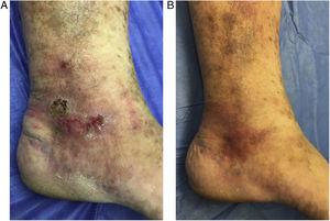 A, Venous ulcer before treatment. B, Complete resolution 4 weeks after beginning treatment, with evident improvement of the surrounding skin.