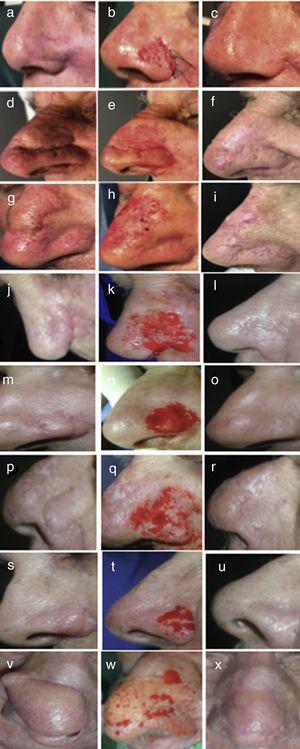 Postoperative outcomes of super shaving. A, D, G, J, M, P, S, V, We can see the trapdoor defect prior to surgery. B, E, H, K, N, Q,T, W, The intraoperative outcome of the technique is shown. C, F, L, O, R, U, X, Postoperative control at 3 months. I, Postoperative control after 1 month.