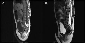 A: MRI T1 4mm lipoma. B: MRI T2 filum terminale with tethered cord.