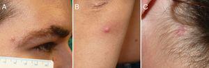 A, Slightly erythematous papular lesion at the edge of the right eyebrow. B, Erythematous lesion on the left forearm. C, Slightly erythematous plaque on the left side of the neck.