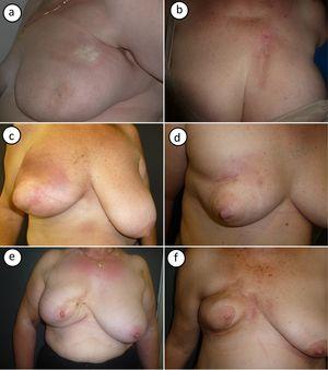 Photographs showing the cases of postirradiation morphea in this series. A (case #1), Morphea on the upper part of the breast, near the armpit. Large, round indurated plaque with a smooth surface, an ivory color, and a violaceous border. B (case #2), Morphea on the upper part of the breast. Highly indurated plaque on an area of radiodermatitis. C, D (cases #3, #4), Inflammatory-stage morphea affecting the entire breast. Inflammation with erythema and generalized breast induration, with sparing of the nipple area. E, F (#cases 5,6), Findings compatible with more residual disease. Pronounced breast retraction and postinflammatory hyperpigmentation.