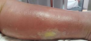 Shiny, erythematous plaque on the leg with irregular borders and superficial vesicles and blisters.