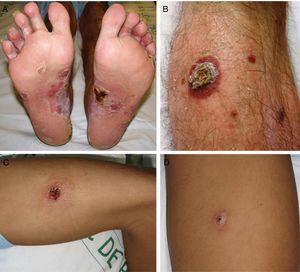 Skin lesions in Patients 3 (A, B) and 4 (C, D).