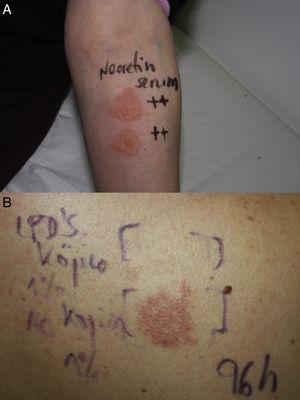 A, Semi-occlusive patch test with the skin lightening product on the patient's forearm at 48hours. B, Patch test results at 96hours with the products supplied by the manufacturer. Positive reaction to kojic acid in 1% water solution.