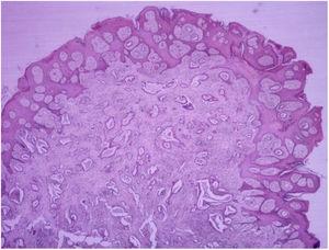 Skin with metastasis from adenocarcinoma. Hematoxylin-eosin, original magnification ×20.