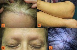 A, Receding hairline and isolated hairs (known as lonely hairs). B, Total alopecia of the eyebrows, with preservation of the eyelashes. C, Hair loss on the arms. D, White patches, arborizing vessels, hairs of different diameters, and follicular hyperkeratosis.