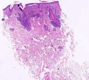 Hematoxylin and eosin stain×2, chronic inflammatory perifollicular and periadnexal infiltrate with vacuolar thickening and degeneration of the basal layer.